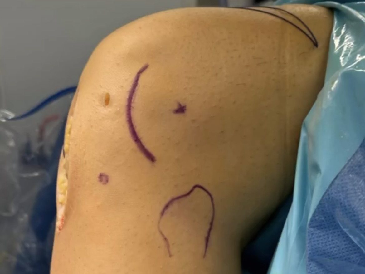 Cara externa de una rodilla preparada en quirófano, con el marcado de las referencias óseas y de la incisión para la tenodesis de Lemaire